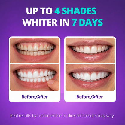 Purple Whitening Strips